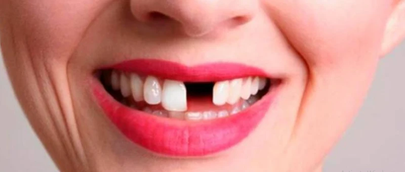 أهم 20 تفسير لحلم سقوط سن واحد لبن سيرين تفسير حلم سقوط سن واحد تشير إلى الكثير من التفسيرات والمعاني التي تختلف وتتعدد من رؤية لأخرى ويرجع ذلك إلى الأحداث المختلفة التي تقع خلال ا