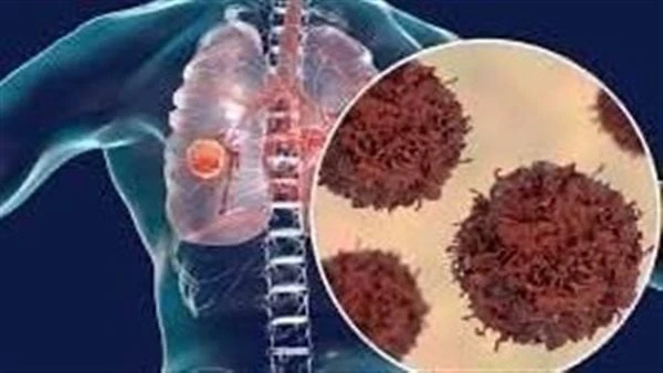 عادة شائعة أحد أسباب الإصابة بسرطان الرئة.. احذرهايعتبر سرطان الرئة هو نوع من السرطانات يبدأ في الرئتين، وهي عبارة عن إسفنجيين في صدرك يسحبان