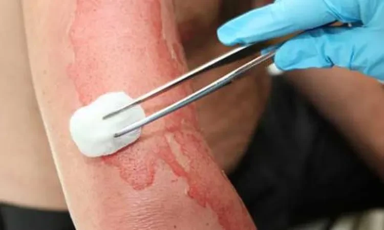 أفضل طرق علاج حروق الماء الساخن.. غير مكلفة وموجودة في كل بيت صحة شاهد المقال التالي من صحافة مصر عن أفضل طرق علاج حروق الماء الساخن غير مكلفة وموجودة في كل بيت، تعتبر حروق الماء ا