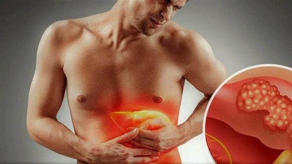 مضاعفاته خطيرة.. هؤلاء الأشخاص الأكثر عرضة للكبد الدهني يعد الكبد الدهني من أخطر الأمراض التي يجب عدم إهمال علاجها حيث أنها تسبب مضاعفات خطيرة قد تصل