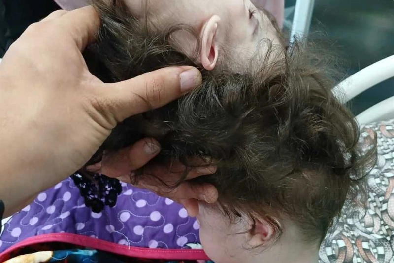 استغرقت 10 ساعات.. عملية جراحية نادرة لفصل توأم ملتصق عن طريق الرأس والمخ بجامعة الإسكندرية في سابقة أولى بمستشفيات جامعة الاسكندرية، نجح فريق طبى