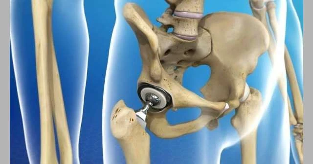 ثلاثية الأبعاد.. علماء يطورون طريقة جديدة لإنتاج مفاصل اصطناعية أخف وأقل تكلفة لايف ستايل شاهد المقال التالي من صحافة البحرين عن ثلاثية الأبعاد علماء