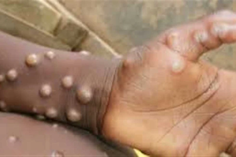 استشاري يكشف عن أعراض جدري القرود والفئات المعرضة للإصابة (فيديو) كشف الدكتور أمجد الحداد استشاري الحساسية والمناعة، تفاصيل مرض جدري القرود، المنتشر