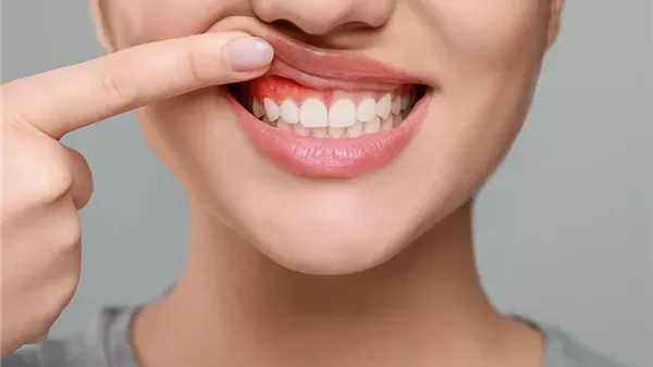 لو بتعاني من نزيف اللثة.. تعرف على أشهر أسباب حدوثهاتتعدد الأسباب المؤدية إلى نزيف اللثة؛ لكن السبب الأكثر شيوعا هو الالتهاب البكتيري، فينتج نزيف