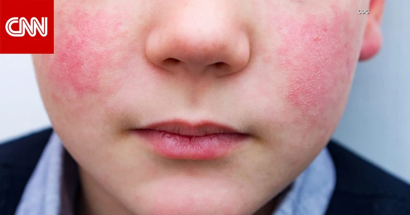 ما هو فيروس بارفو 19 بعد تحذير أمريكا من ارتفاع حالات الإصابة؟ تكنولوجيا تكنولوجيا، ما هو فيروس بارفو 19 بعد تحذير أمريكا من ارتفاع حالات