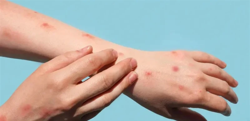 افريقيا تعلن مرض جدري القرود حالة طوارئ عامة صحة شاهد المقال التالي من صحافة لبنان عن افريقيا تعلن مرض جدري القرود حالة طوارئ عامة، أعلنت الهيئة