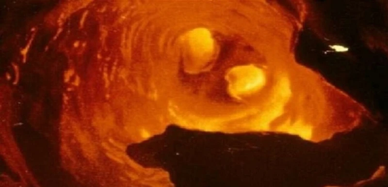 هل يمكن علاج تصلب الشرايين؟ صحة شاهد المقال التالي من صحافة لبنان عن هل يمكن علاج تصلب الشرايين؟، يعبر مصطلح تصلب الشرايين بصورة دقيقة عن نشوء تكوينات متينة من النسيج الضام على جدر