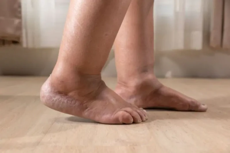 حسام موافي يحدد أسباب تورم القدمينوصف الدكتور حسام موافي، أستاذ الحالات الحرجة بكلية طب قصر العيني، مجموعة نصائح مهمة لتجنب تورم القدمين.وأضاف حسام