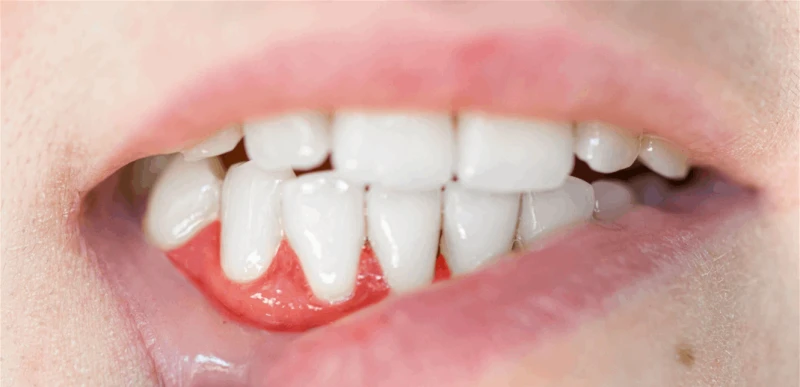 التهابات اللثة.. خطر يهدد الصحة العامة إذا لم يتم معالجته صحة صحة، التهابات اللثة خطر يهدد الصحة العامة إذا لم يتم معالجته،أفاد تقرير حديث نشر على موقع هيلث الطبي أن التهابات اللثة