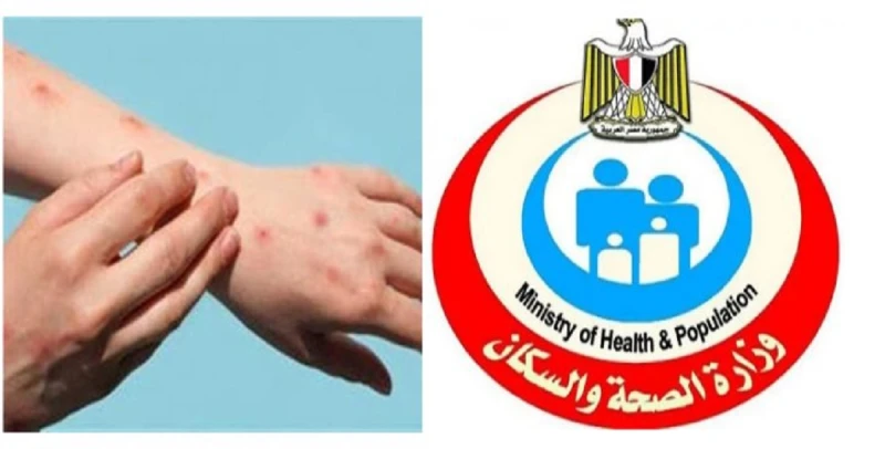 الصحة تعلن طرق انتقال جدري القرود من شخص إلى اخر وترفع درجة الاستعداد القصويالصحة تعلن طرق انتقال جدري القرود من شخص إلى اخر وترفع درجة الاستعداد القصوي.. أعلنت وزارة الصحة والسكان