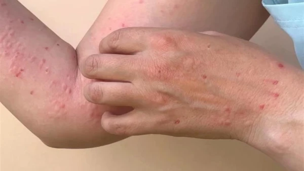 سنغافورة ترصد 13 حالة إصابة بجدري القرود لايف ستايل لايف ستايل، سنغافورة ترصد 13 حالة إصابة بجدري القرود،أعلنت وزارة الصحة في سنغافورة، الخميس، أنها سجلت 13 حالة إصابة بالسلالة الف