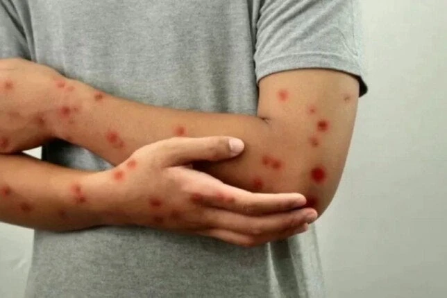 متخصص فيروسات يكشف مفاجأة صادمة عن أسباب انتشار جدري القرودقال الدكتور يحيى مكي، متخصص في علم الفيروسات، إن أحد أسباب انتشار مرض جدري القرود هو