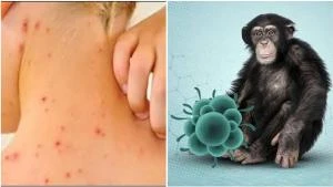 كيف ينتقل جدري القرود عن طريق الجلود والفراء صحة وجمال صحة وجمال، كيف ينتقل جدري القرود عن طريق الجلود والفراء،وكالات السوسنةينشغل العالم بمعرفة كافة