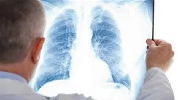 بإتباع هذه النصائح.. أحمي نفسك من الإلتهاب الرئوييعد الالتهاب الرئوي عدوى تؤدي إلى التهاب الحويصلات الهوائية في إحدى الرئتين أو كلتيهما، وقد تملأ