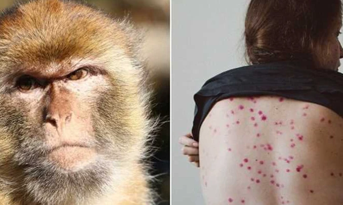 إجراء عاجل من الصحة بعد إعلان جدري القردة حالة طوارئ صحية عامة مرض جدري القرودفي أول إجراء عاجل اتخذته وزارة الصحة بعد إعلان الهيئة الصحية التابعة