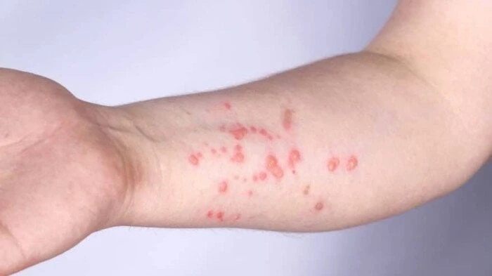 منظمة الصحة العالمية تطلق خطة لوقف تفشي جدري القرودجدري القرود.. تزداد التساؤلات بشكل يومي من قبل الكثير من المواطنين حول العالم، عن مرض جدري القرود