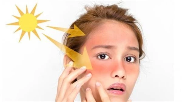 في الحر والصيف .. إليك طرق الوقاية من حروق الشمس تعد حروق الشمس من المشكلات الشائعة خلال فصل الصيف خاصة عند الخروج المصايف والمنتزهات وحتى من يذهبون للعمل بشكل يومي في ساعات النهار