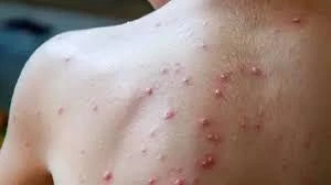 الهند تعمل على تطوير لقاح جديد لمكافحة جدري القردة متفرقات متفرقات، الهند تعمل على تطوير لقاح جديد لمكافحة جدري القردة،الهند تعمل على تطوير لقاح جديد