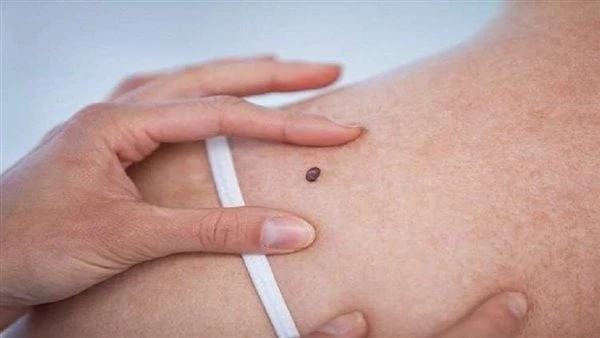 سرطان الجلد.. 6 أعراض غير متوقعة تؤكد إصابتك بالمرضسرطان الجلد هو أحد أكثر أنواع السرطان شيوعا على مستوى العالم، لكنه أيضا أحد أكثر أنواع السرطان