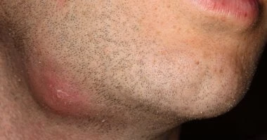 لا تهملها.. أشهر مضاعفات الخراج الخطيرة.. من الندبات حتى اختراق العظم صحة وطب شاهد المقال التالي من صحافة مصر عن لا تهملها أشهر مضاعفات الخراج