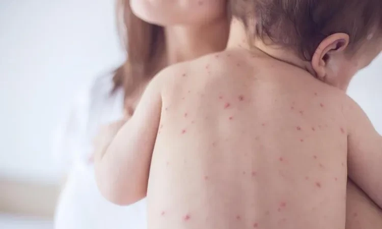 أكلات ممنوعة على مرضى الجدري المائي في الصيف.. أبرزها الأطعمة الحارة صحة شاهد المقال التالي من صحافة مصر عن أكلات ممنوعة على مرضى الجدري المائي في الصيف أبرزها الأطعمة الحارة، انتش