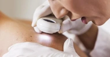 متى يجب القلق من الشامات الجلدية.. علامات هتقولك صحة وطب صحة وطب، متى يجب القلق من الشامات الجلدية علامات هتقولك،الشامات هى نتوءات جلدية داكنة اللون