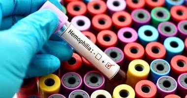 7 حقائق حول مرض الهيموفيليا.. تعرف عليها صحة وطب شاهد المقال التالي من صحافة مصر عن 7 حقائق حول مرض الهيموفيليا تعرف عليها، الهيموفيليا هو اضطراب