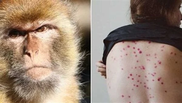 احم نفسك وأسرتك من الإصابة بفيروس جدري القرود.. نصائح هامةفيروس جدري القرود واحد من الأمراض النادرة، والجرذان والفئران والقرود من يصابون به،