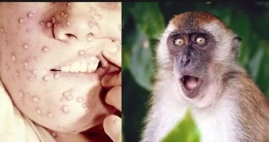 هل ينتقل جدرى القرود عن طريق الطعام؟ صحة وطب صحة وطب، هل ينتقل جدرى القرود عن طريق الطعام؟،جدرى القرود ذلك المرض الذى ينتقل من الحيوان للإنسان وهو عبارة عن عدوى فيروسية، له الكثير 