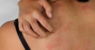 طرق علاج الطفح الجلدى بالصبار صحة وطب صحة وطب، طرق علاج الطفح الجلدى بالصبار،الطفح الجلدى من الأمراض الجلدية التى يمكن علاجها فى المنزل عن طريق