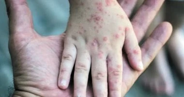 هل يتسبب تفشى جدرى القرود فى إغلاق كامل على غرار كورونا؟ تقرير يوضح صحة وطب صحة وطب، هل يتسبب تفشى جدرى القرود فى إغلاق كامل على غرار كورونا؟ تقرير