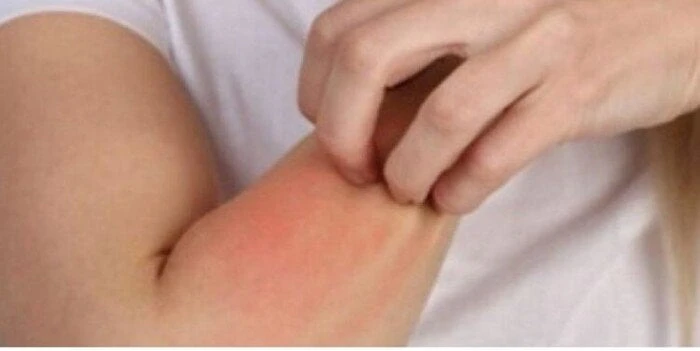 منها الكمادات الباردة وجل الصبار.. طرق علاج حساسية الجلد والهرش للكبار منوعات الاسبوع منوعات الاسبوع، منها الكمادات الباردة وجل الصبار طرق علاج