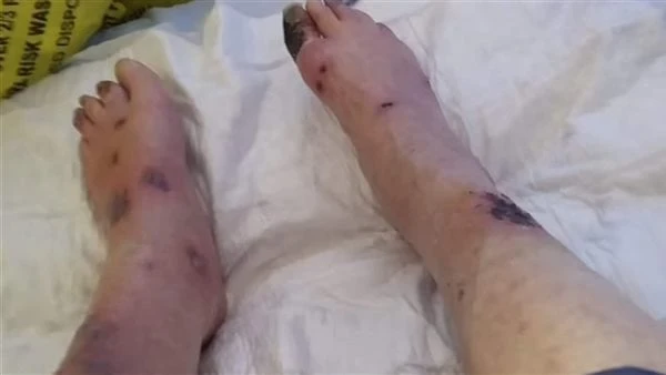 سيدة تفقد ساقيها بسبب لدغة بعوضأثار خبر ضجة علي السوشيال ميديا بسبب إصابة سيدة مسنة بمرض خطير اضطرت لبتر ساقيها بعد أن تعرضت للدغة بعوض أثناء تواجدها في حديقتها.جوزي رولي، تبلغ من