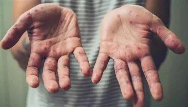 عودة جدري القرود يصيب العالم بالرعب.. والصحة العالمية تعلن حالة الطوارئجدري القرود.. حالة من الرعب سيطرت على العالم بعد تحذير منظمة الصحة العالمية من