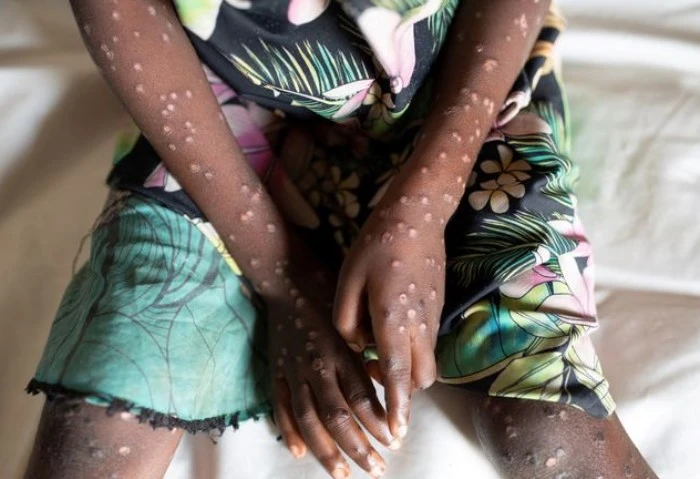 وزير الصحة : مصر خالية من أي إصابات بجدري القرود جدري القرود، تحرص الدولة المصرية، والقيادة السياسية متمثلة في الرئيس عبدالفتاح السيسي، على تقديم