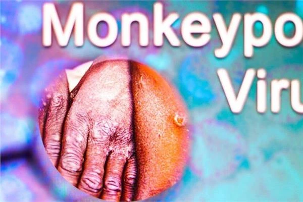 الصحة العالمية تعقد اجتماعا طارئا لمواجهة تفشي جدري القردة متفرقات شاهد المقال التالي من صحافة مصر عن الصحة العالمية تعقد اجتماعا طارئا لمواجهة تفشي