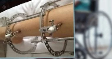 جراحة كسر العظام لزيادة الطول تتسبب في إعاقة صينيين المرأة والمنوعات المرأة والمنوعات، جراحة كسر العظام لزيادة الطول تتسبب في إعاقة صينيين،أثارت