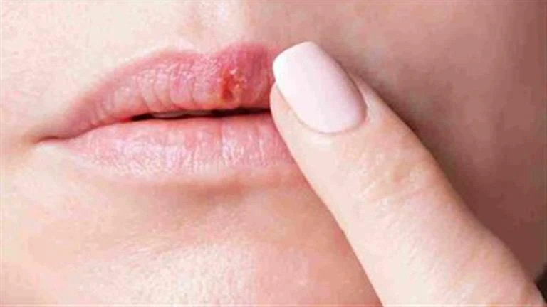 علامات خطيرة ل سرطان الشفاه.. وكم من الوقت يستغرق انتشاره في الجسم؟ لايف ستايل لايف ستايل، علامات خطيرة ل سرطان الشفاه وكم من الوقت يستغرق انتشاره في