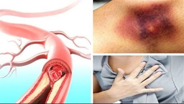 أطعمة تعرضك للإصابة بالسكتة الدماغية والموت المفاجئتحدث السكتات الدماغية عندما يتم تقييد أو انسداد تدفق الدم إلى المخ، وعادة ما يكون ذلك بسبب جلطة