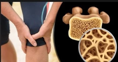 العلاجات الطبيعية لتعزيز قوة العظام وتقليل الالتهاب صحة وطب صحة وطب، العلاجات الطبيعية لتعزيز قوة العظام وتقليل الالتهاب،يعد نقص فيتامين د أكثر شيوعا