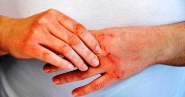 الصدفية مش إكزيما.. اعرف الفرق بينهما والعلاجات الطبيعية لهما صحة وطب شاهد المقال التالي من صحافة مصر عن الصدفية مش إكزيما اعرف الفرق بينهما