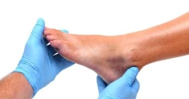 الغرغرينا.. اعرف أسباب الإصابة والأعراض وطرق العلاج صحة وطب صحة وطب، الغرغرينا اعرف أسباب الإصابة والأعراض وطرق العلاج،الغرغرينا هي حالة خطيرة تهدد