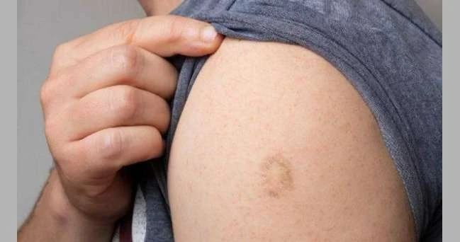 بشرى سعيدة.. تطعيم الطفولة يوفر حماية مقبولة ضد جدري القرود لايف ستايل لايف ستايل، بشرى سعيدة تطعيم الطفولة يوفر حماية مقبولة ضد جدري القرود،أظهرت