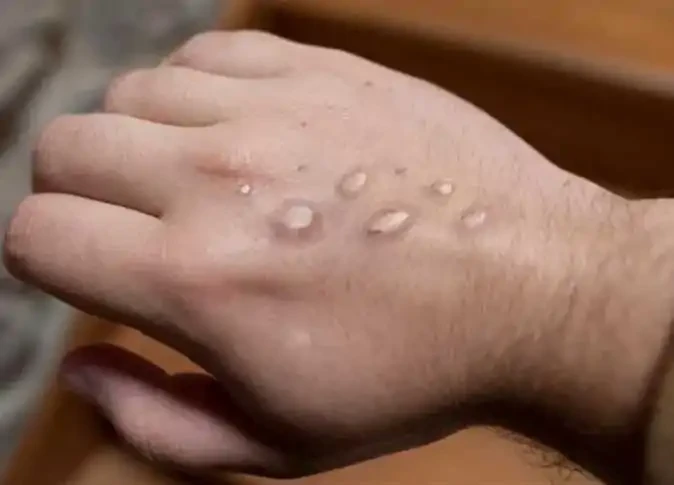 وزارة الصحة تحسم الجدل المنتشر بشأن انتشار جدري القرود في مصرحقيقة انتشار جدري القرود في مصر أعلنت وزارة الصحة والسكان أن مصر خالية من فيروس جدرى