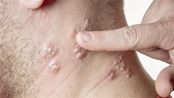 بعد انتشاره في السودان معلومات صادمة عن مرض أبو الصميقأكدت وزارة الصحة في السودان انتشار مرض أبو الصميق، والذي يسمى التهاب الجلد البكتيري، وهو سريع