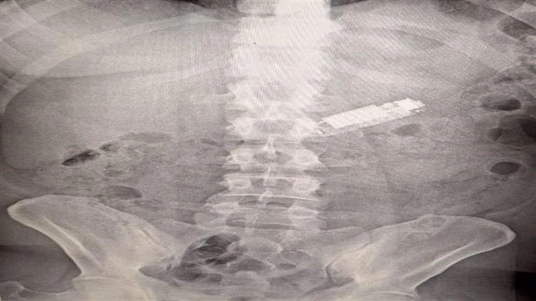 ظل 5 أشهر في معدته.. استخراج محمول من بطن مريض لايف ستايل لايف ستايل، ظل 5 أشهر في معدته استخراج محمول من بطن مريض،05 00 م الأحد 25 أغسطس 2024 في