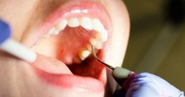لمشاكل الأسنان.. تعرف على مضاعفات التهابات اللثة الخطيرة صحة وطب صحة وطب، لمشاكل الأسنان تعرف على مضاعفات التهابات اللثة الخطيرة،التهابات اللثة مشكلة
