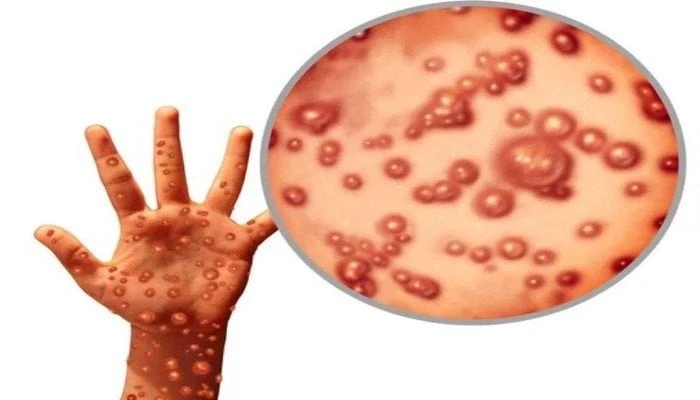 عودة جدري القرود ما السبب؟ منوعات الاسبوع شاهد المقال التالي من صحافة مصر عن عودة جدري القرود ما السبب؟، أثارت عودة جدري القرود بين البشر مخاوف