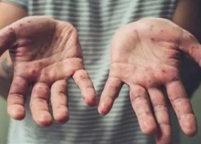 الصحة المصرية تصدر 4 إجراءات عاجلة عقب أكتشاف أول إصابة بجدري القرود الصحة المصرية تصدر 4 إجراءات عاجلة عقب أكتشاف أول إصابة بجدري القرود صوت المسيحي