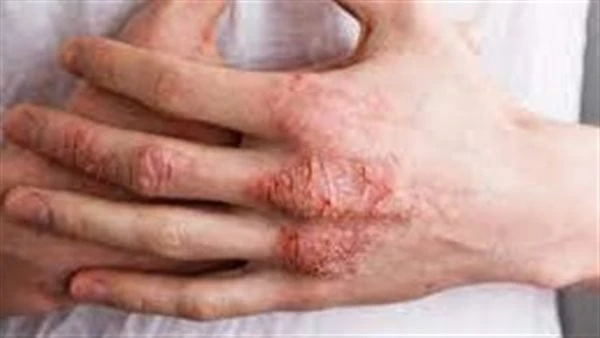 تسبب ألما شديدا.. طرق الوقاية من الأكزيما تعد الأكزيما من المشكلات الشائعة التي تسبب التهابا في الجلد قد تصل للرغبة في الحكة الشديدة.ووفقا لما جاء في موقع مايو كلينك نعرض لكم طرق ا